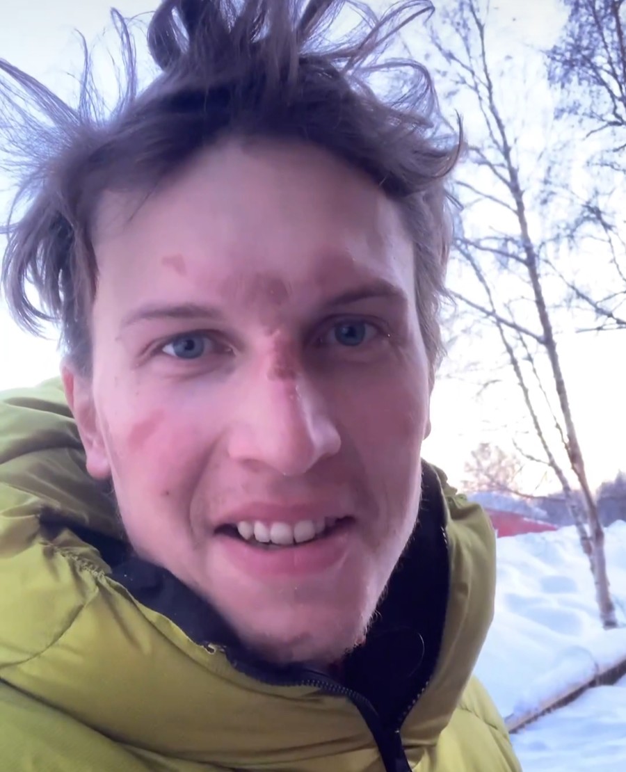 Jost Kobusch, con algunas congelaciones en la cara, regresa del Denali. Foto: Jost Kobusch